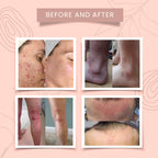 Herbal Eczema & Psoriasis Relief Cream