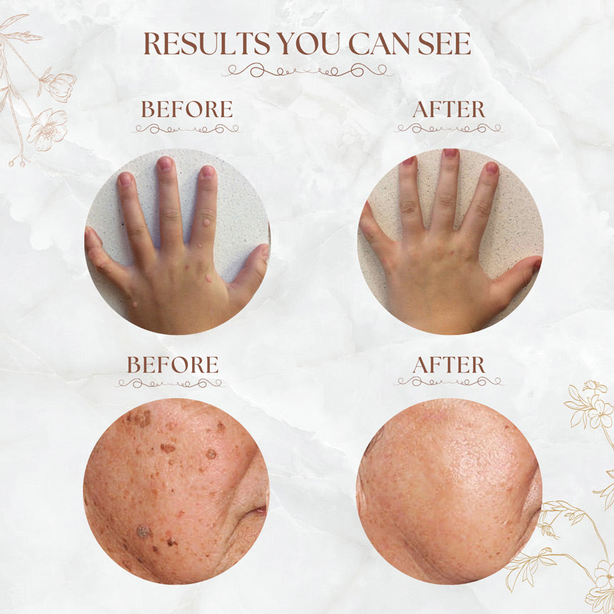 Fast-Acting Liquid Wart Remover